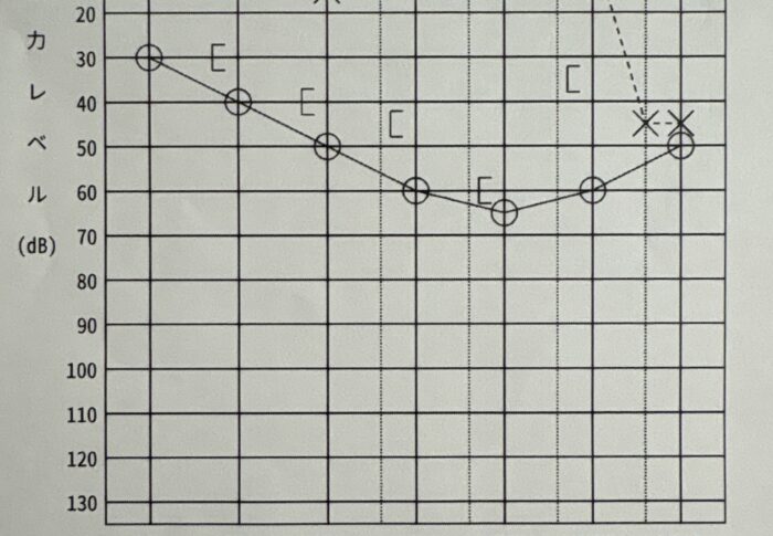 突発性難聴 発症4日目