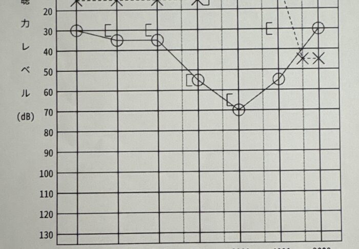 突発性難聴 発症1日目