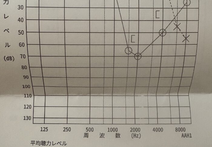 突発性難聴 41日目