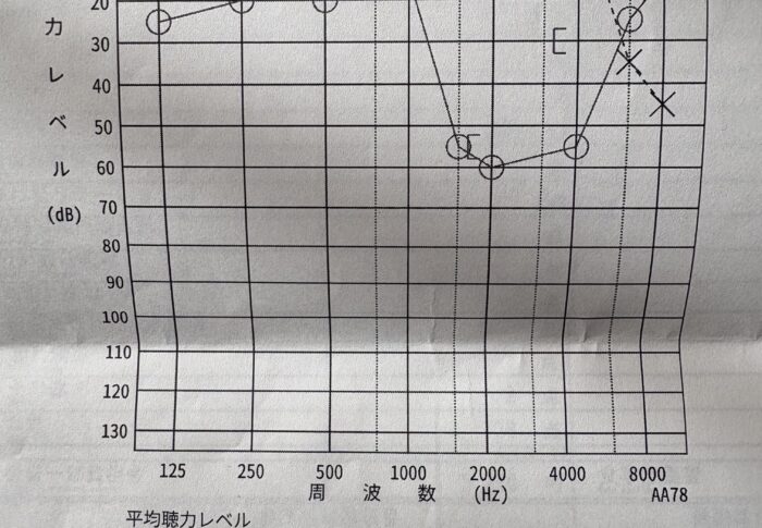 突発性難聴 発症から約2ヶ月